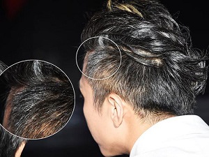少白头是一种早衰标志吗？