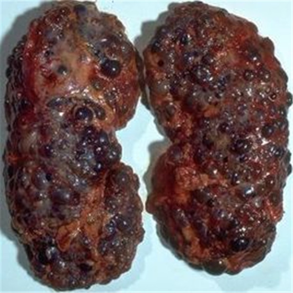 肾囊肿有哪些症状?如果预防?(内附图片略恶心,慎点)